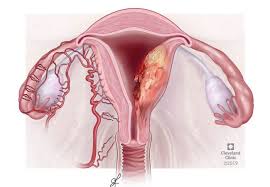 Kanser Ginekologi: Saringan, Faktor Risiko & Pengesanan Awal