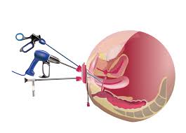 Kemajuan Pembedahan Ginekologi: Pendekatan Moden dalam Penjagaan Kesihatan Wanita