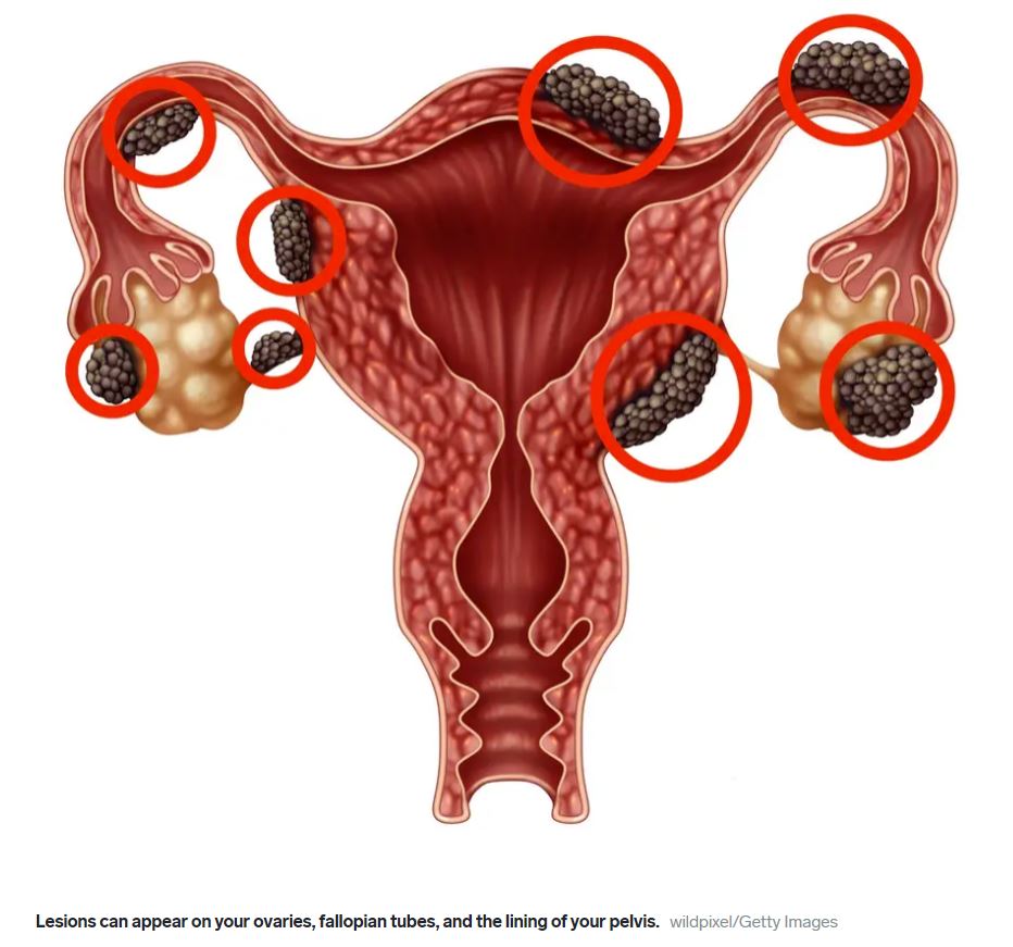 Endometriosis: Kesakitan Senyap, Perjuangan Tersembunyi